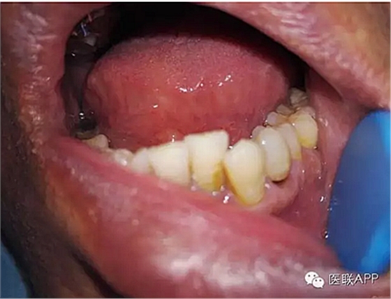 楔狀缺損導致根尖周炎 楔狀缺損導致根尖周炎