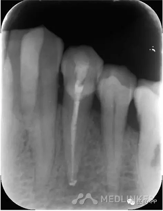楔狀缺損導致根尖周炎 楔狀缺損導致根尖周炎