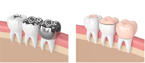 牙樁、牙冠、活動義齒修復(fù)材料，怎么選？