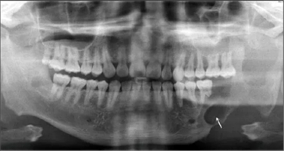 下頜骨腓骨移植聯(lián)合牙種植術(shù)后的覆蓋義齒修復(fù)1例 下頜骨腓骨移植聯(lián)合牙種植術(shù)后的覆蓋義齒修復(fù)1例