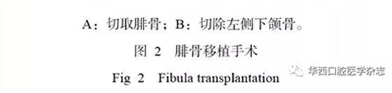 下頜骨腓骨移植聯(lián)合牙種植術(shù)后的覆蓋義齒修復(fù)1例 下頜骨腓骨移植聯(lián)合牙種植術(shù)后的覆蓋義齒修復(fù)1例