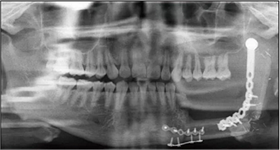 下頜骨腓骨移植聯(lián)合牙種植術(shù)后的覆蓋義齒修復(fù)1例 下頜骨腓骨移植聯(lián)合牙種植術(shù)后的覆蓋義齒修復(fù)1例