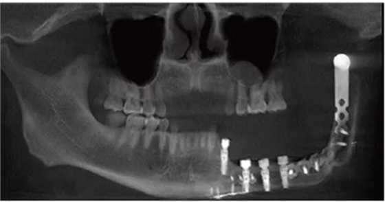 下頜骨腓骨移植聯(lián)合牙種植術(shù)后的覆蓋義齒修復(fù)1例 下頜骨腓骨移植聯(lián)合牙種植術(shù)后的覆蓋義齒修復(fù)1例
