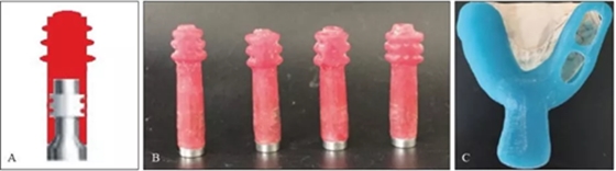 下頜骨腓骨移植聯(lián)合牙種植術(shù)后的覆蓋義齒修復(fù)1例 下頜骨腓骨移植聯(lián)合牙種植術(shù)后的覆蓋義齒修復(fù)1例