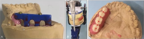 下頜骨腓骨移植聯(lián)合牙種植術(shù)后的覆蓋義齒修復(fù)1例 下頜骨腓骨移植聯(lián)合牙種植術(shù)后的覆蓋義齒修復(fù)1例