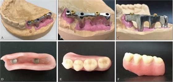 下頜骨腓骨移植聯(lián)合牙種植術(shù)后的覆蓋義齒修復(fù)1例 下頜骨腓骨移植聯(lián)合牙種植術(shù)后的覆蓋義齒修復(fù)1例