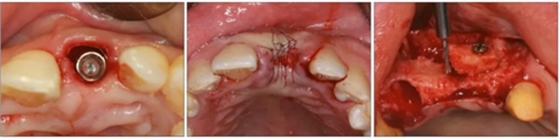 【專家共識(shí)】種植修復(fù)臨床評(píng)價(jià)標(biāo)準(zhǔn) 【專家共識(shí)】種植修復(fù)臨床評(píng)價(jià)標(biāo)準(zhǔn)