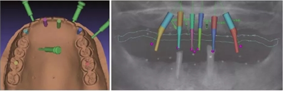 【專家共識(shí)】種植修復(fù)臨床評(píng)價(jià)標(biāo)準(zhǔn) 【專家共識(shí)】種植修復(fù)臨床評(píng)價(jià)標(biāo)準(zhǔn)