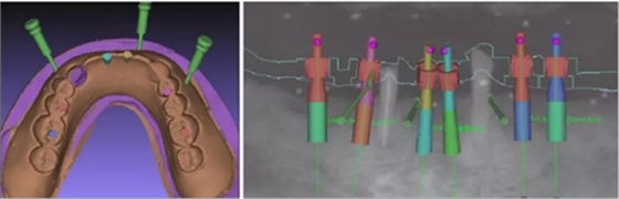 【專家共識(shí)】種植修復(fù)臨床評(píng)價(jià)標(biāo)準(zhǔn) 【專家共識(shí)】種植修復(fù)臨床評(píng)價(jià)標(biāo)準(zhǔn)