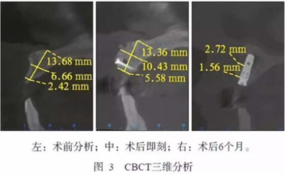 【專家共識(shí)】種植修復(fù)臨床評(píng)價(jià)標(biāo)準(zhǔn) 【專家共識(shí)】種植修復(fù)臨床評(píng)價(jià)標(biāo)準(zhǔn)