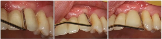 【專家共識(shí)】種植修復(fù)臨床評(píng)價(jià)標(biāo)準(zhǔn) 【專家共識(shí)】種植修復(fù)臨床評(píng)價(jià)標(biāo)準(zhǔn)