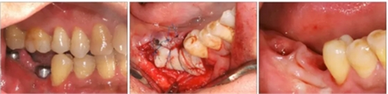 【專家共識(shí)】種植修復(fù)臨床評(píng)價(jià)標(biāo)準(zhǔn) 【專家共識(shí)】種植修復(fù)臨床評(píng)價(jià)標(biāo)準(zhǔn)