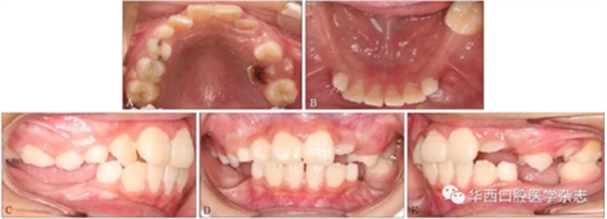 右下頜第一磨牙遠中水平阻生1例 右下頜第一磨牙遠中水平阻生1例