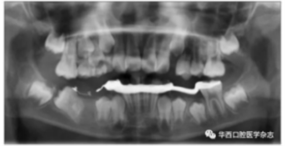 右下頜第一磨牙遠中水平阻生1例 右下頜第一磨牙遠中水平阻生1例