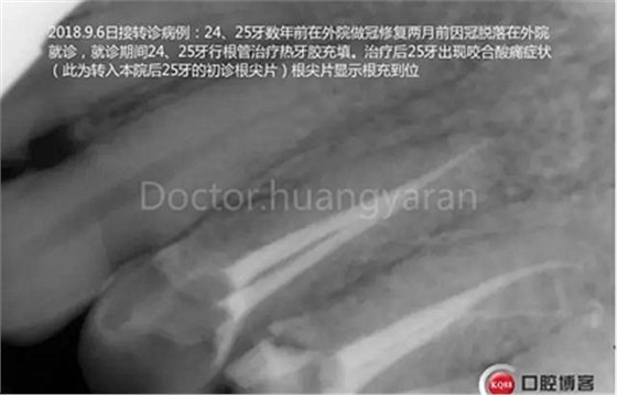 當(dāng)根管治療遇見根尖骨穿孔 當(dāng)根管治療遇見根尖骨穿孔