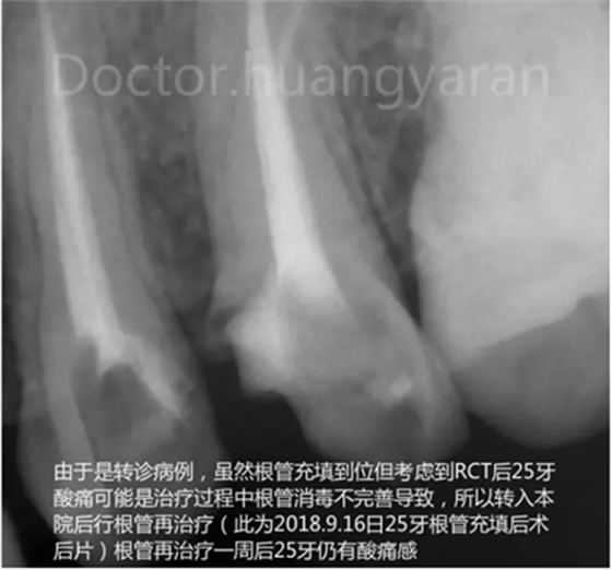 當(dāng)根管治療遇見根尖骨穿孔 當(dāng)根管治療遇見根尖骨穿孔