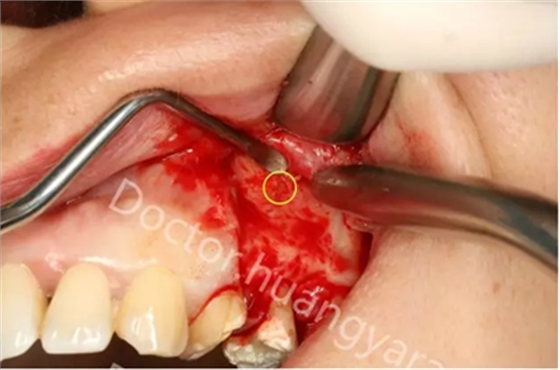 當(dāng)根管治療遇見根尖骨穿孔 當(dāng)根管治療遇見根尖骨穿孔