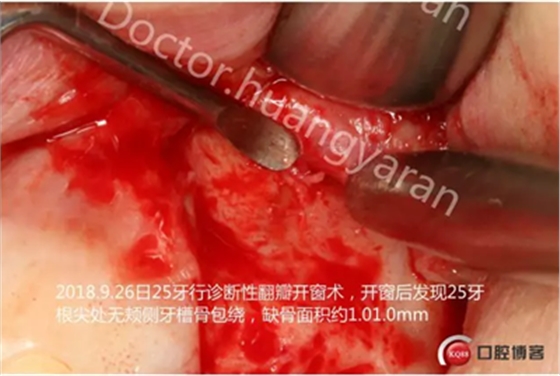 當(dāng)根管治療遇見根尖骨穿孔 當(dāng)根管治療遇見根尖骨穿孔