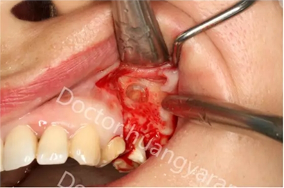 當(dāng)根管治療遇見根尖骨穿孔 當(dāng)根管治療遇見根尖骨穿孔
