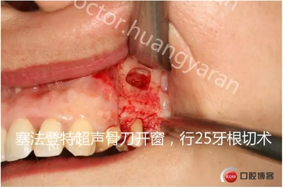 當(dāng)根管治療遇見根尖骨穿孔 當(dāng)根管治療遇見根尖骨穿孔