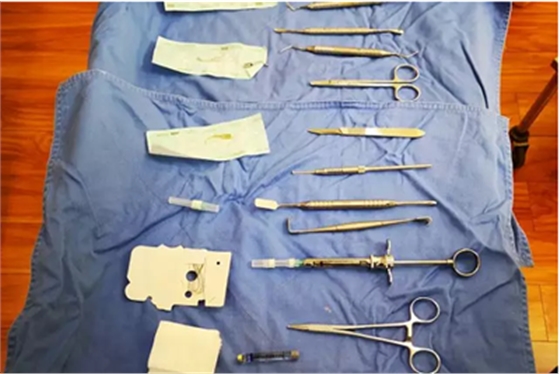 A當(dāng)根管治療遇見根尖骨穿孔 A當(dāng)根管治療遇見根尖骨穿孔