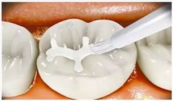 兒童齲病的預(yù)防 兒童齲病的預(yù)防