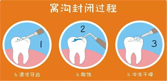 兒童齲病的預(yù)防 兒童齲病的預(yù)防
