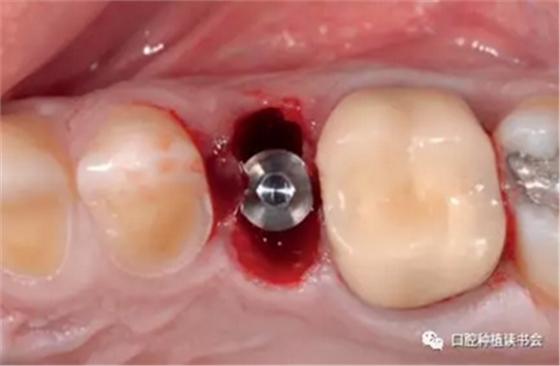 牙科種植 牙科種植