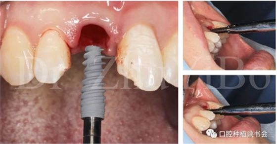牙科種植 牙科種植