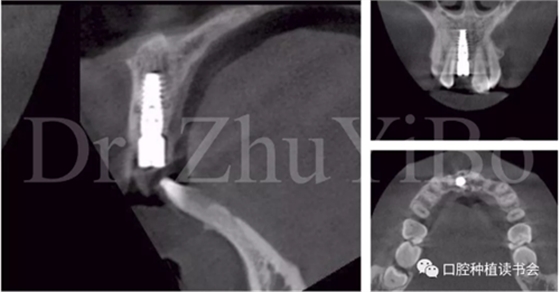 牙科種植 牙科種植