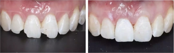 牙科種植 牙科種植