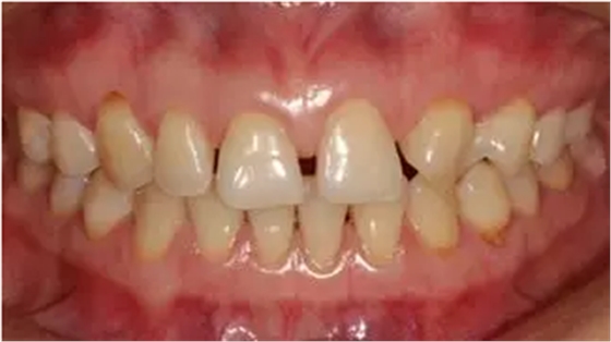 病例分享|復(fù)合樹脂微創(chuàng)美學(xué)修復(fù)關(guān)閉上前牙間隙 病例分享|復(fù)合樹脂微創(chuàng)美學(xué)修復(fù)關(guān)閉上前牙間隙