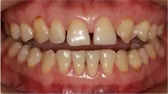 病例分享|復(fù)合樹脂微創(chuàng)美學(xué)修復(fù)關(guān)閉上前牙間隙 病例分享|復(fù)合樹脂微創(chuàng)美學(xué)修復(fù)關(guān)閉上前牙間隙