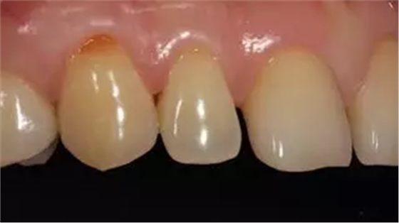 病例分享|復(fù)合樹脂微創(chuàng)美學(xué)修復(fù)關(guān)閉上前牙間隙 病例分享|復(fù)合樹脂微創(chuàng)美學(xué)修復(fù)關(guān)閉上前牙間隙