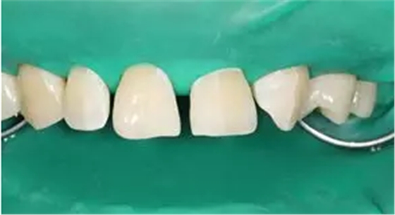 病例分享|復(fù)合樹脂微創(chuàng)美學(xué)修復(fù)關(guān)閉上前牙間隙 病例分享|復(fù)合樹脂微創(chuàng)美學(xué)修復(fù)關(guān)閉上前牙間隙