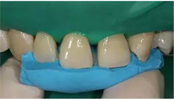 病例分享|復(fù)合樹脂微創(chuàng)美學(xué)修復(fù)關(guān)閉上前牙間隙 病例分享|復(fù)合樹脂微創(chuàng)美學(xué)修復(fù)關(guān)閉上前牙間隙