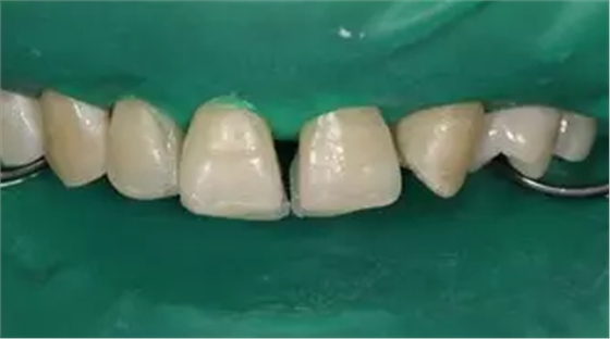 病例分享|復(fù)合樹脂微創(chuàng)美學(xué)修復(fù)關(guān)閉上前牙間隙 病例分享|復(fù)合樹脂微創(chuàng)美學(xué)修復(fù)關(guān)閉上前牙間隙