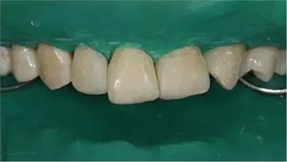 病例分享|復(fù)合樹脂微創(chuàng)美學(xué)修復(fù)關(guān)閉上前牙間隙 病例分享|復(fù)合樹脂微創(chuàng)美學(xué)修復(fù)關(guān)閉上前牙間隙