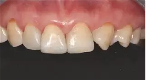 病例分享|復(fù)合樹脂微創(chuàng)美學(xué)修復(fù)關(guān)閉上前牙間隙 病例分享|復(fù)合樹脂微創(chuàng)美學(xué)修復(fù)關(guān)閉上前牙間隙