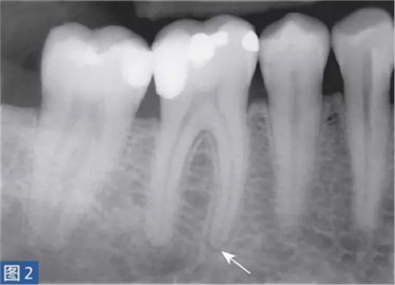 根尖周炎的病因與癥狀 根尖周炎的病因與癥狀