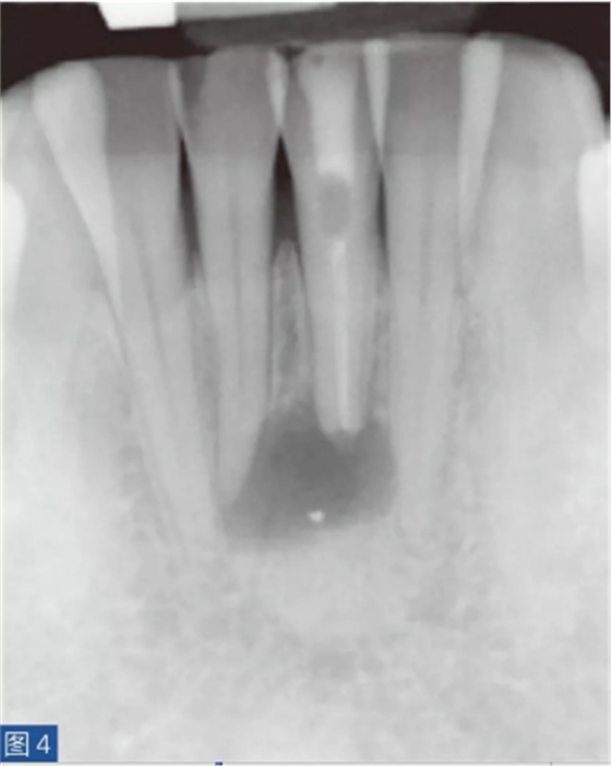 根尖周炎的病因與癥狀 根尖周炎的病因與癥狀