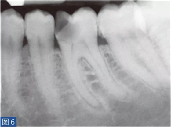 根尖周炎的病因與癥狀 根尖周炎的病因與癥狀
