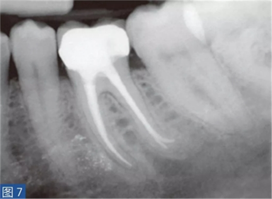 根尖周炎的病因與癥狀 根尖周炎的病因與癥狀