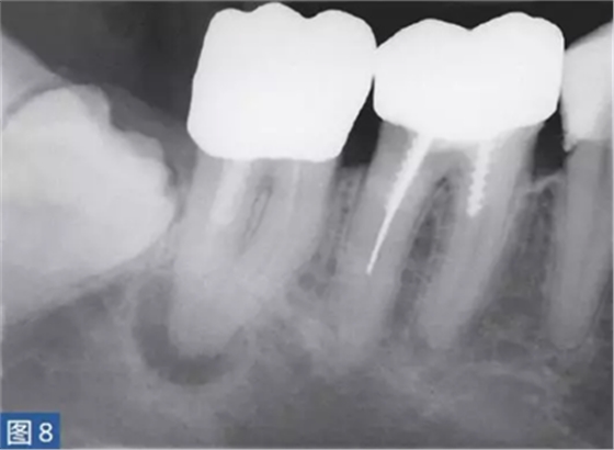 根尖周炎的病因與癥狀 根尖周炎的病因與癥狀