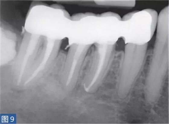 根尖周炎的病因與癥狀 根尖周炎的病因與癥狀