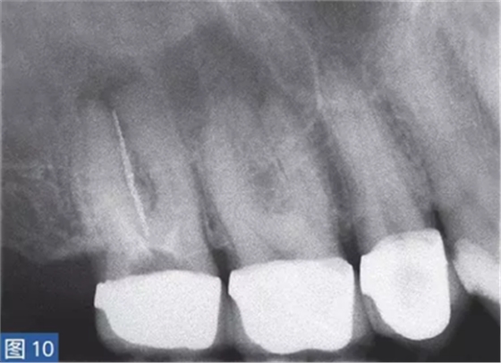 根尖周炎的病因與癥狀 根尖周炎的病因與癥狀