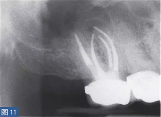 根尖周炎的病因與癥狀 根尖周炎的病因與癥狀