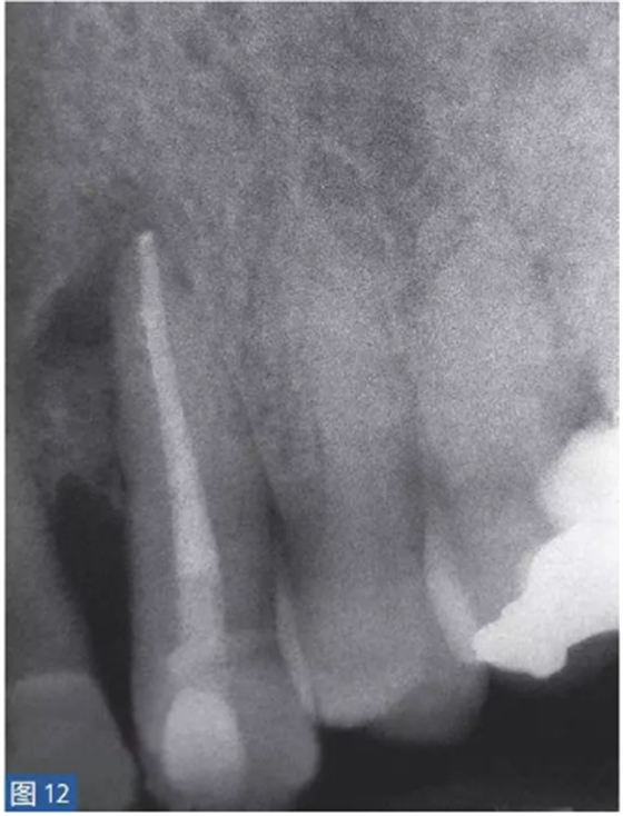 根尖周炎的病因與癥狀 根尖周炎的病因與癥狀