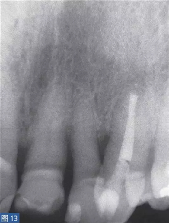 根尖周炎的病因與癥狀 根尖周炎的病因與癥狀