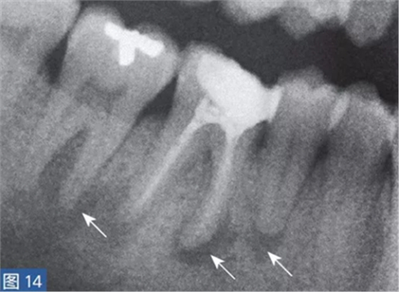根尖周炎的病因與癥狀 根尖周炎的病因與癥狀